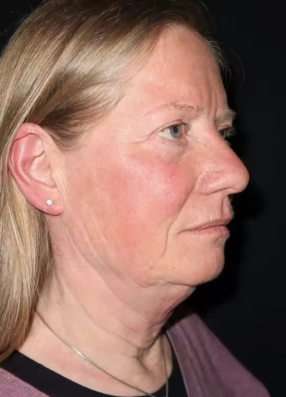 Vorher